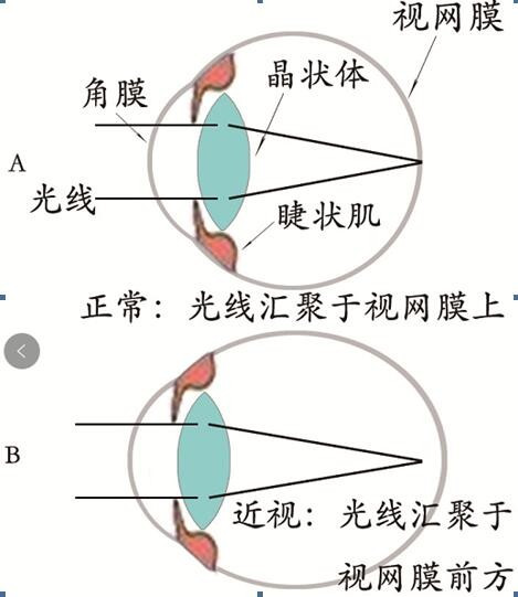 眼睛近视了怎样才能恢复