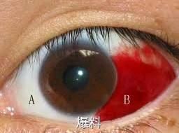 眼睛红红的像出血一样是怎么回事？揉眼是大忌